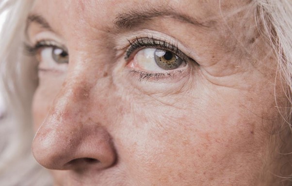 Cuperosis: ¿Qué es y qué tratamientos existen? 