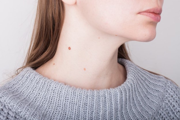 Por qué salen verrugas en el cuello
