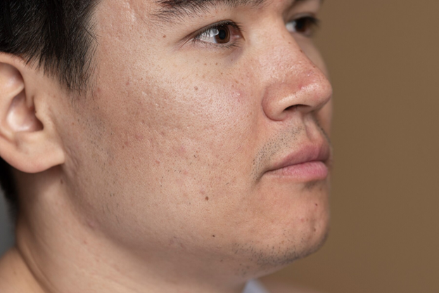 Cómo quitar manchas en la cara: opciones y consejos