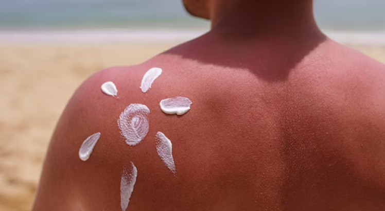 ¿Cómo tratar quemaduras del sol?