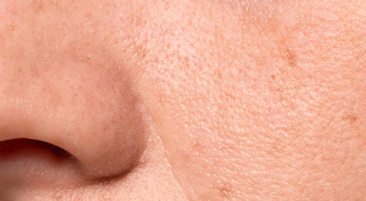 Cómo quitar la grasa de la cara