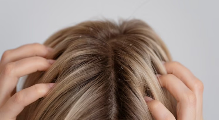 ¿Cuál es el mejor champú antiscaspa? 